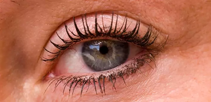 rheumatoid arthritis and eyes - Uveitis and Iritis